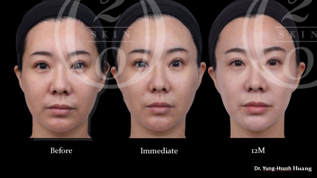 台中舒顏萃推薦4d童顏針,真童妍拉提術案例