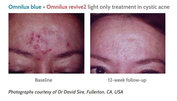 使用Omnilux 歐霓光療儀進行紅藍光合併治療六周後，嚴重型痤瘡獲得明顯改善。