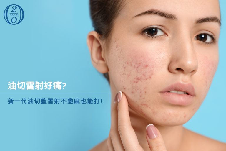 油切雷射好痛?新一代Capri油切藍雷射不敷麻也能打!控油抑菌1機雙波長搞定? 油切雷射好痛?新一代Capri油切藍雷射不敷麻也能打!控油抑菌一機雙波長搞定?