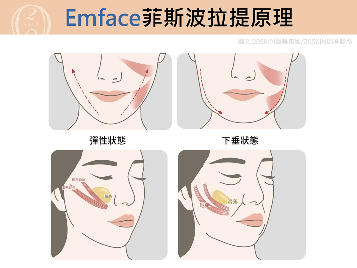 菲斯波Emface拉提原理