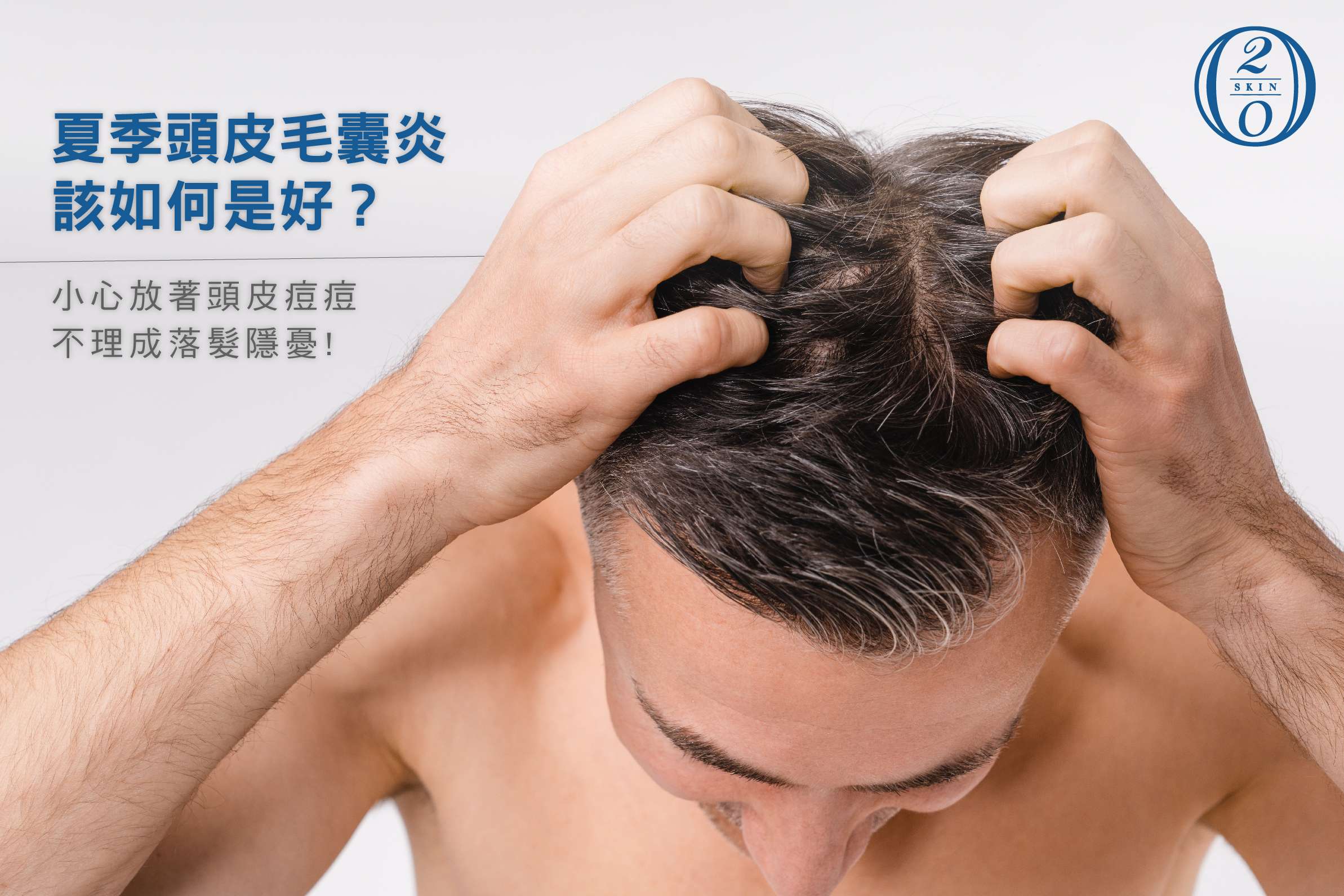 頭皮毛囊炎怎麼辦 小心放著頭皮痘痘不理成落髮隱憂 台中 二林四季皮膚科 skin美醫集團 頭皮毛囊炎怎麼辦 小心放著頭皮痘痘不理成落髮隱憂 台中 二林四季皮膚科 skin美醫集團