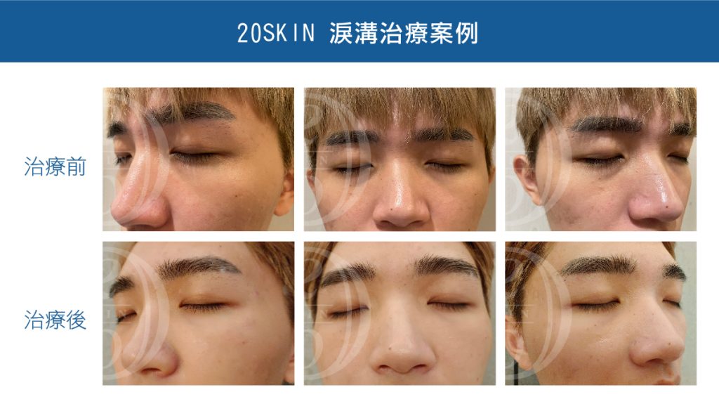 男性舒顏萃淚溝治療推薦成功案例