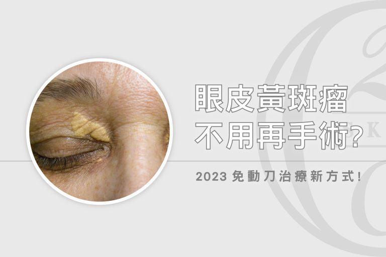 跟黃斑瘤手術疤痕說掰掰!免開刀、零傷口的新一代雷射治療登場! 眼瞼黃斑瘤在眼皮上怎麼辦?黃斑瘤手術已經過時了,用雷射就可以治療了。