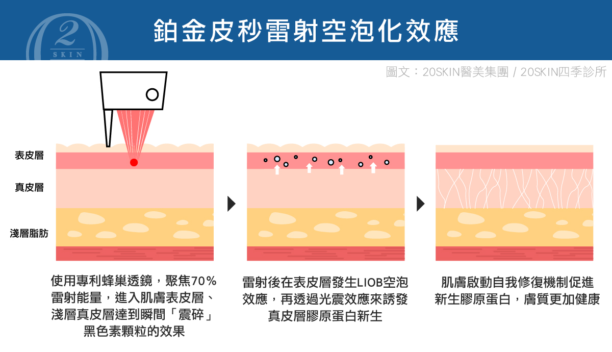 鉑金蜂巢皮秒特殊的透鏡模式，在不破壞表皮的前提下，利用「LIOB空泡效應」刺激真皮層膠原蛋白增生。