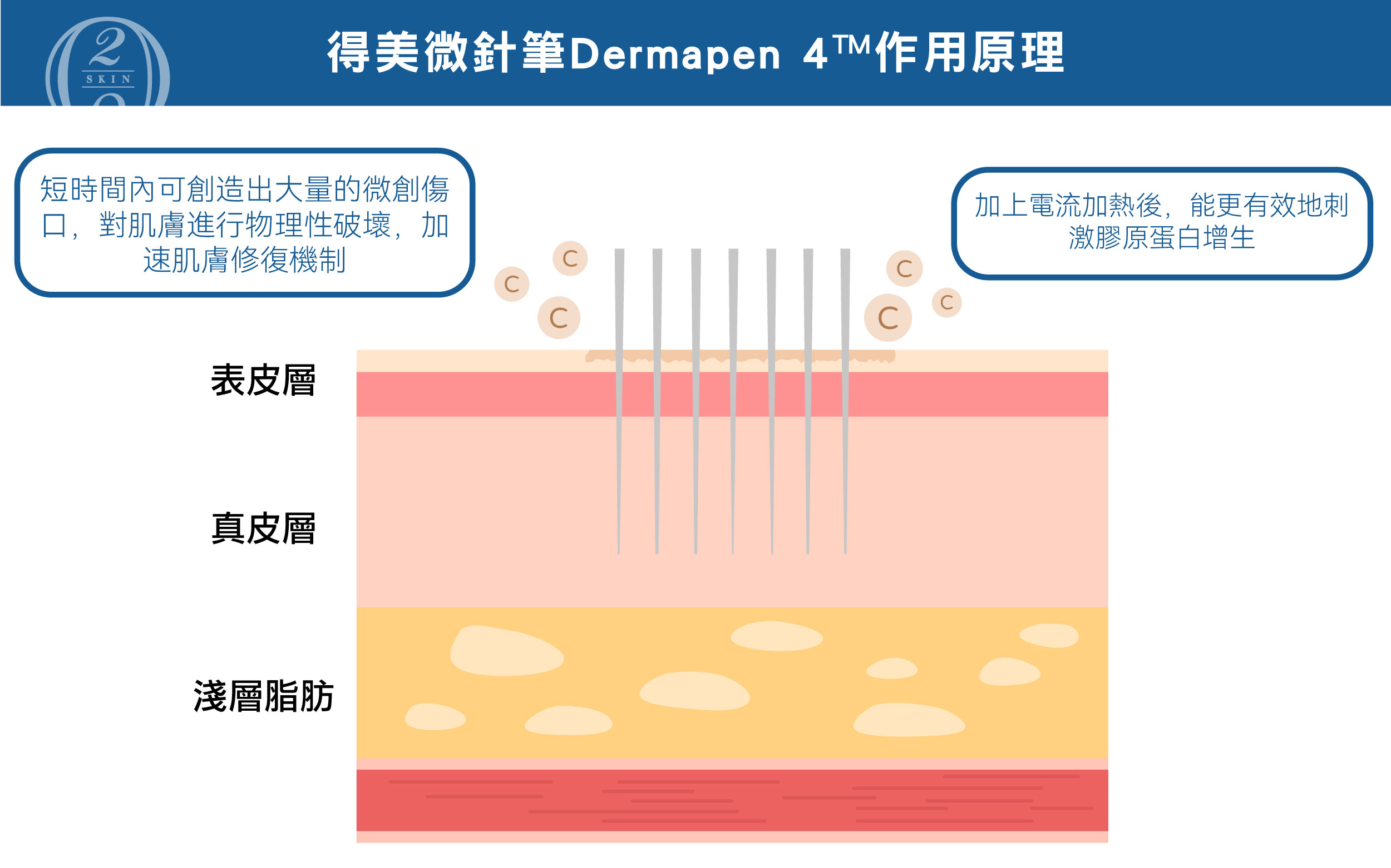 得美微針筆 Dermapen 4™ 透過高速微針技術，在短時間內創造微創傷口，促進皮膚自我修復與膠原蛋白增生，改善痘疤、細紋及毛孔粗大問題。