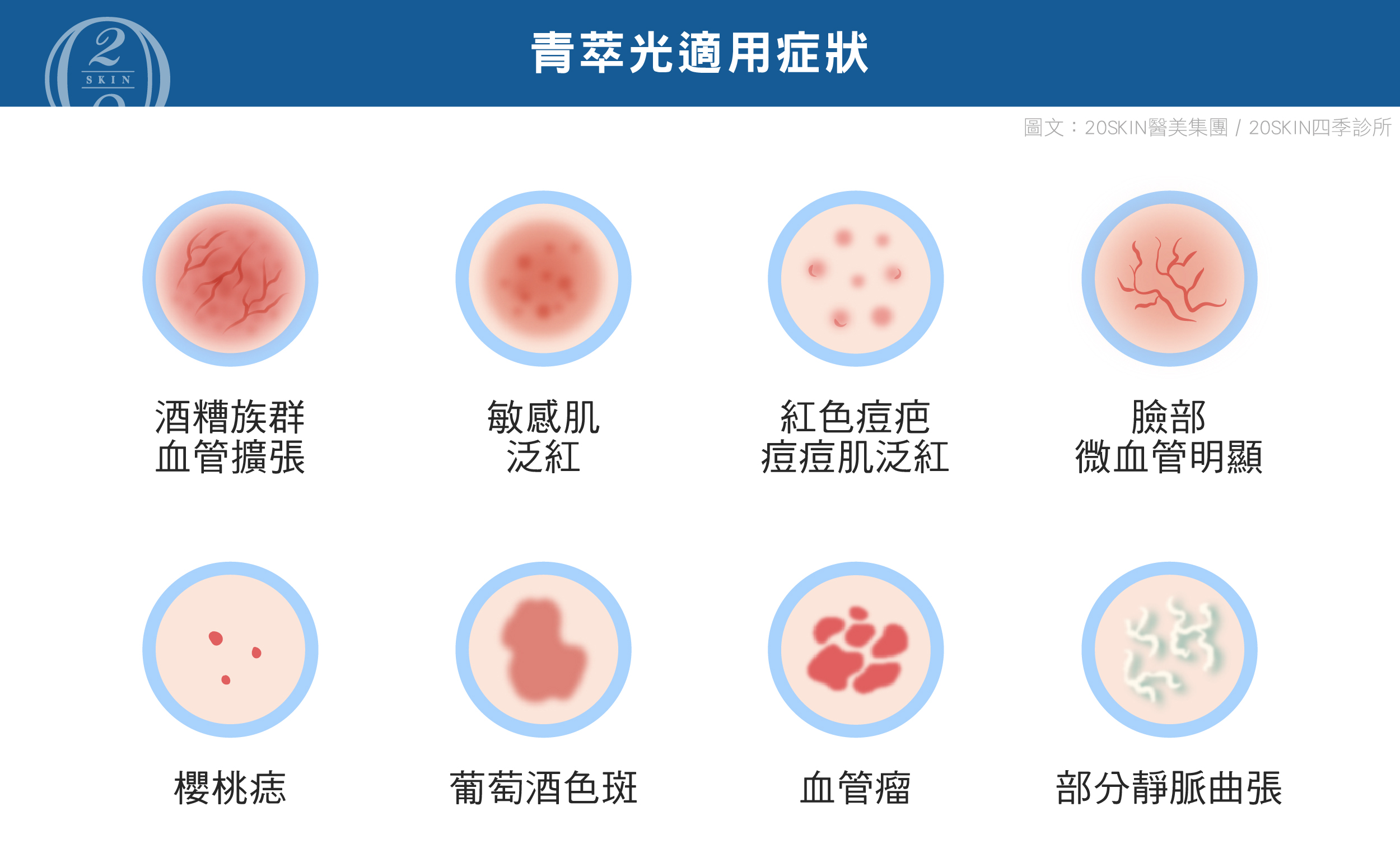 青萃光DermaV 適用於酒糟肌、微血管擴張、紅色痘疤等血管型肌膚問題，透過532nm與1064nm雙波長精準治療，改善泛紅、血管瘤與葡萄酒色斑，提升膚色均勻度，讓肌膚恢復健康透亮狀態。
