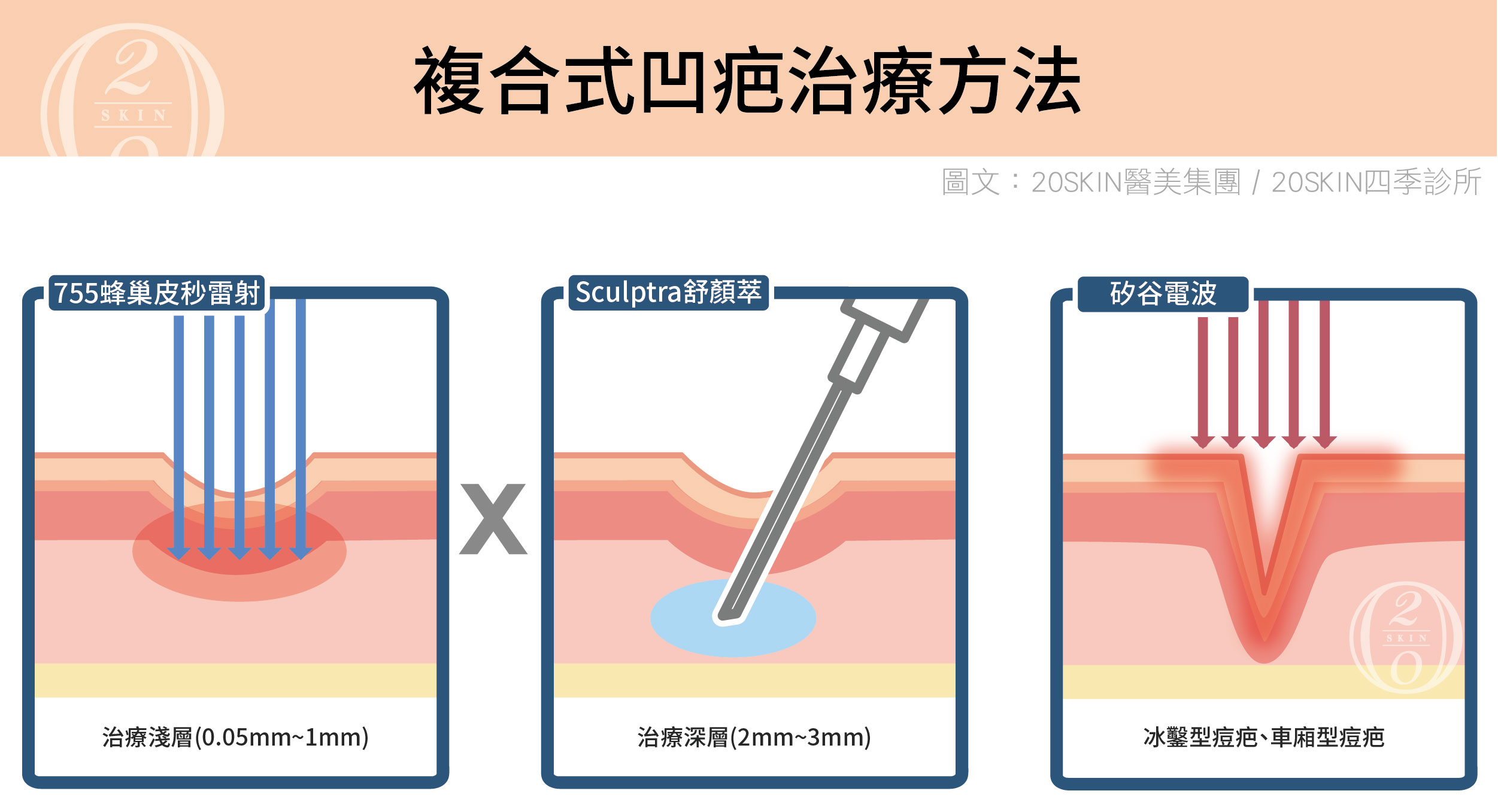 台中凹疤治療推薦！複合式療程修復痘疤凹洞效果更顯著台中四季皮膚科提供755蜂巢皮秒雷射、舒顏萃注射與矽谷電波等複合式凹疤治療，針對冰鑿型、車廂型與滾動型痘疤分層修復，促進膠原蛋白增生，幫助肌膚回復平滑狀態，有效改善各類痘疤問題！