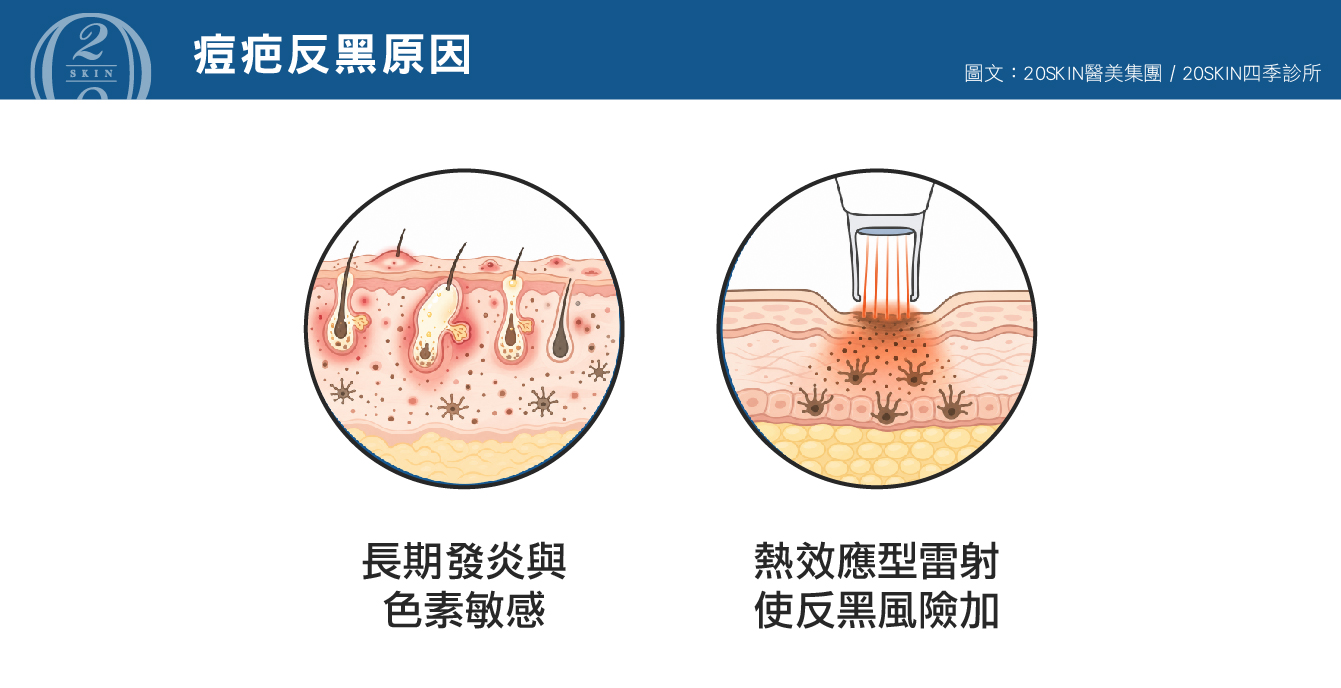 為什麼「處理痘疤」比「處理斑點」更容易反黑?