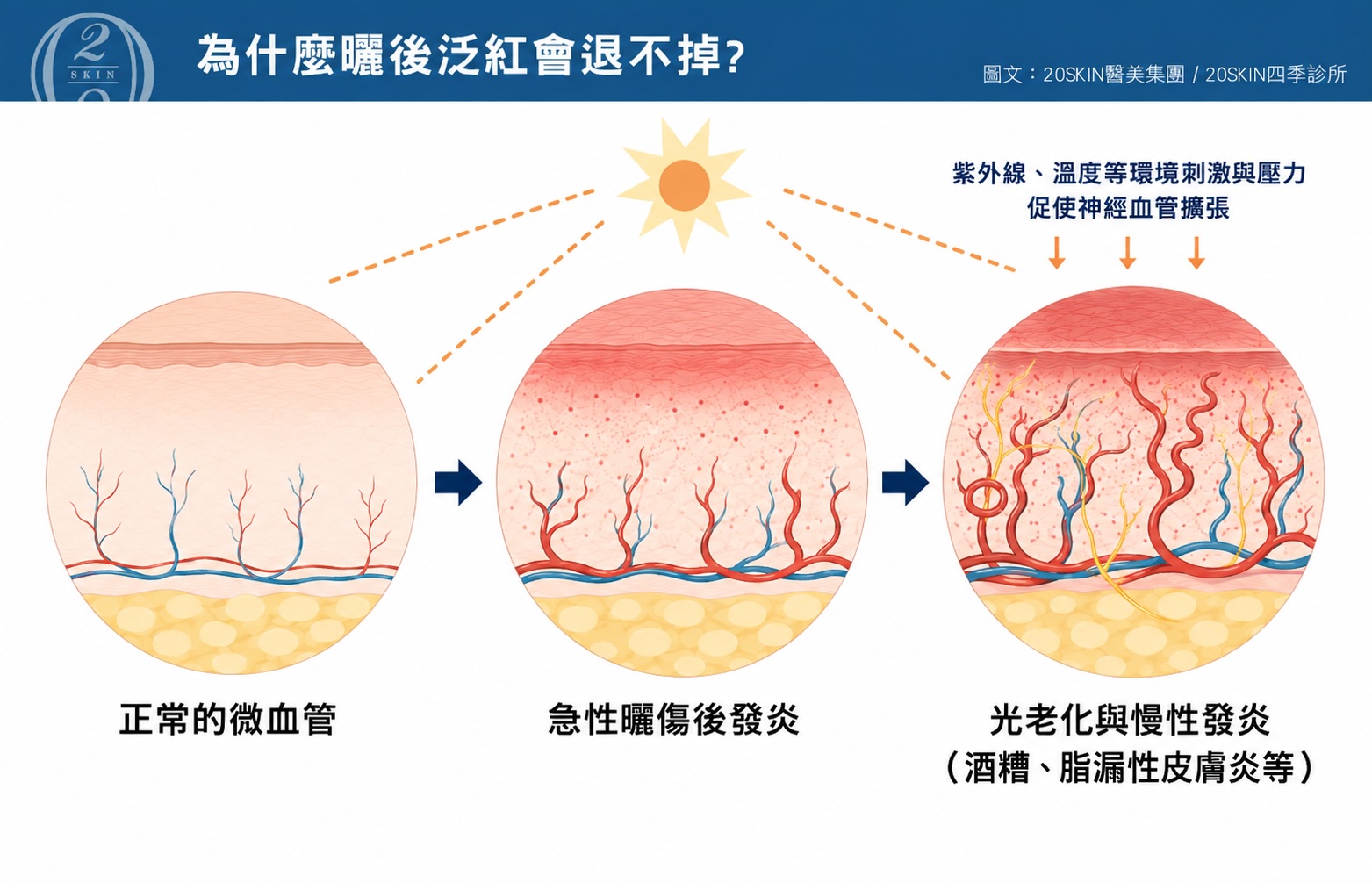 四季診所整理曬後泛紅退不掉原因