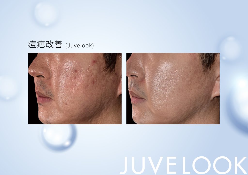 喬雅露在韓國造成轟動遠勝水光針，原因是喬雅露肉眼可見的4大功效：細緻膚質、彈嫩飽滿、改善凹疤、提亮膚色