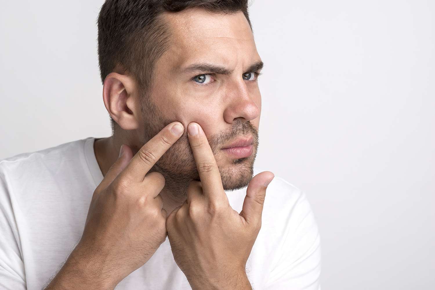 大部分的男性皮膚的皮脂腺分泌出油量更旺盛，更容易有痘痘和粉刺的問題。