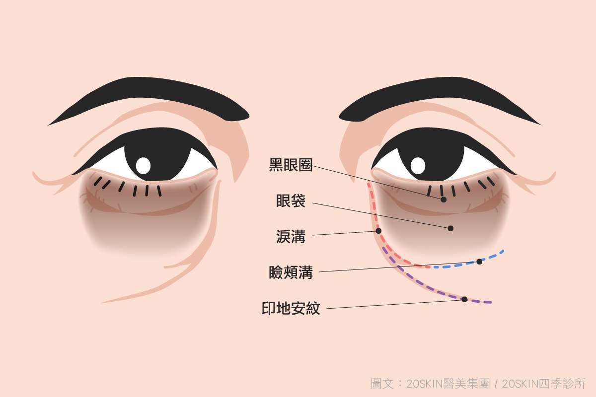 針對淚溝型眼袋，首先要去重建眼周的骨架支撐。