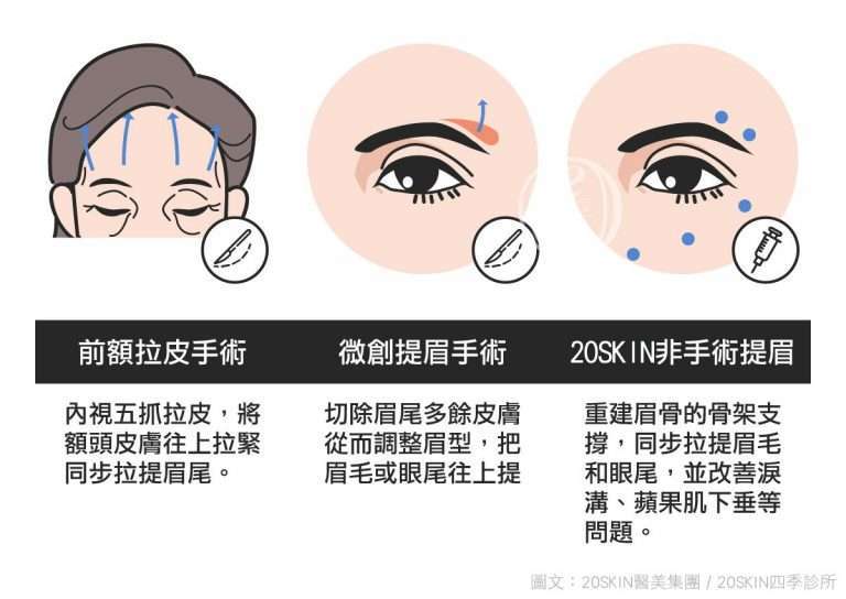 眼尾下垂不必動刀!三種非侵入式療程改善眼周老化 眉眼拉提手術為前額拉皮手術與提眉手術,然後提眉手術費用至少50,000元,恢復期又很常。。