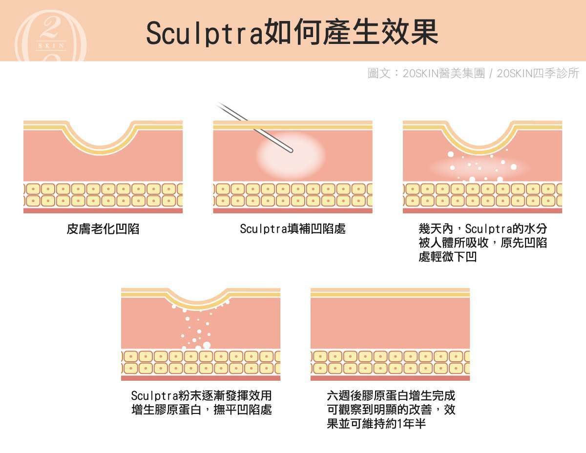 Sculptra舒顏萃(童妍針)的作用原理，可以刺激皮膚膠原蛋白新生