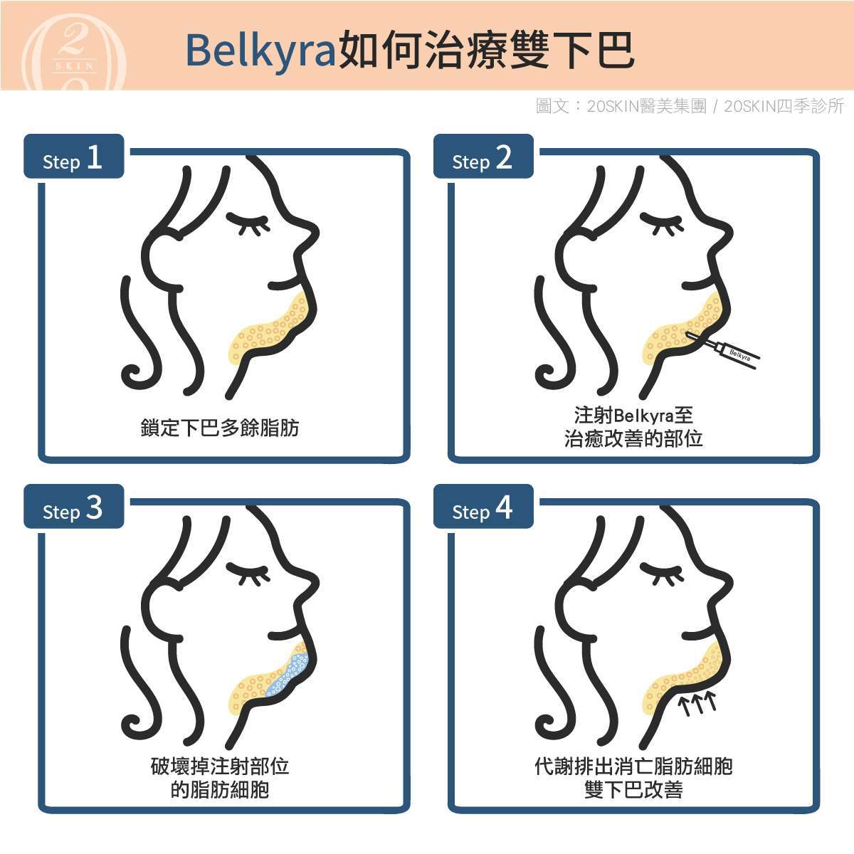 Belkyra消脂針如何治療雙下巴
