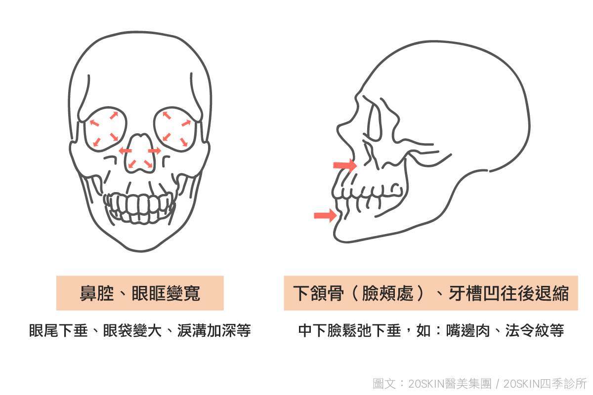 臉部骨架從年輕到老化，可能出現法令紋情況，