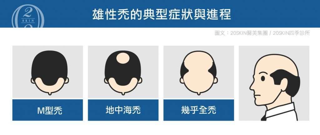 雄性禿是什麼？雄性禿特徵與雄性禿症狀有哪些？有Ｍ型禿、地中海禿等