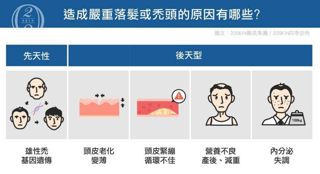 雄性禿女性也會得到嗎?女性雄性禿治療該如何?