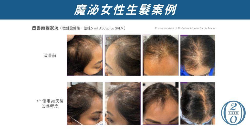 魔泌女性髮量改善案例，通過微針設備結合塗抹外泌體ASCEplus SRLV，4次療程後顯著改善髮量稀疏問題，促進毛囊修復與髮質健康，展現外泌體在調節頭皮環境及提升髮密度的卓越效果，是女性髮量困擾的理想解決方案