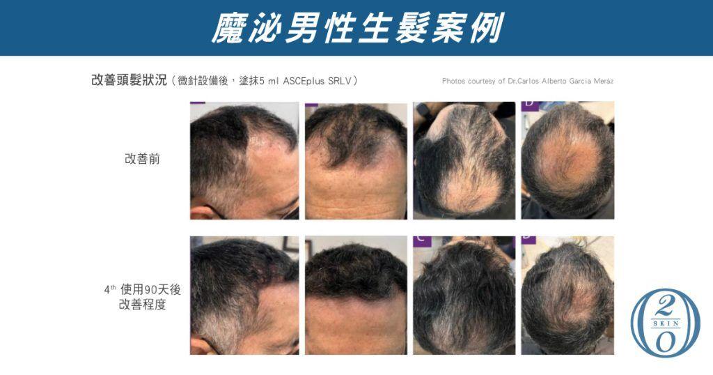 魔泌男性髮量改善案例，運用微針設備搭配塗抹外泌體ASCEplus SRLV，經過4次療程90天後，顯著提升髮量與髮質，展現外泌體在頭皮健康調節及毛囊修復的卓越功效，有效解決男性禿髮問題