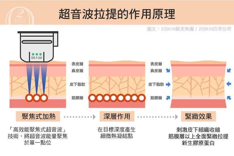 超音波拉提原理圖示