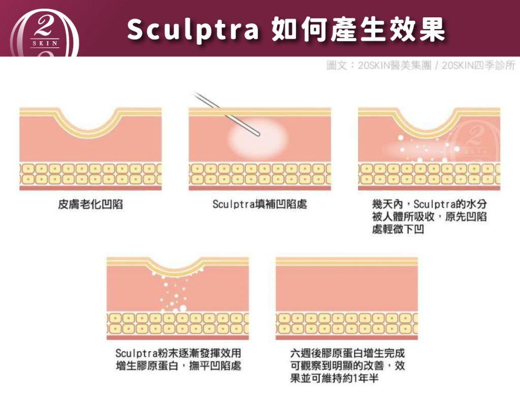 Sculptra童顏針效果原理圖解，展示如何透過刺激膠原蛋白增生，填補皮膚凹陷並持續改善鬆弛及皺紋問題，童顏針效果可維持約一年半，是抗老療程的理想選擇。