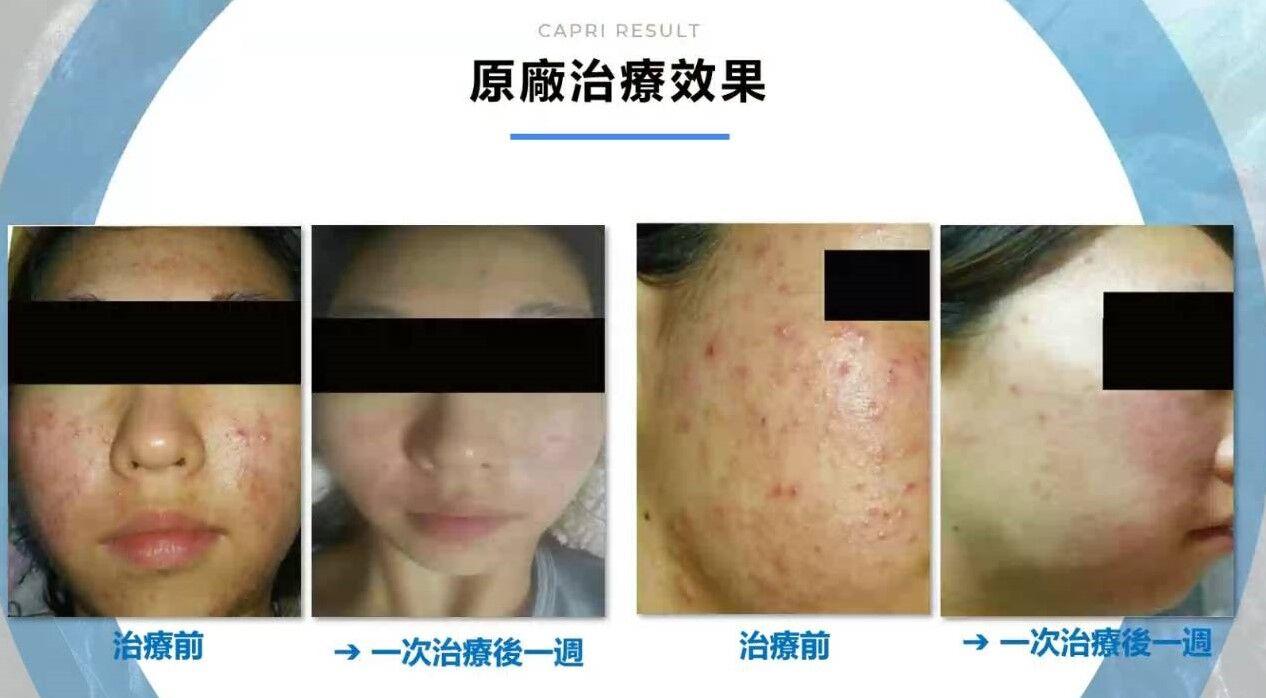 CAPRI藍雷射治療前後效果對比,藍雷射有效改善青春痘與膚質,治療一週後明顯減少皮膚炎症及痘痘問題,適合痘痘肌。