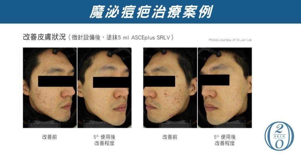 外泌體治療痘疤案例，透過微針設備搭配塗抹ASCEplus SRLV，有效改善皮膚凹洞及痘疤，僅5次療程後即可見顯著變化，展現外泌體於修復肌膚及重建肌膚屏障上的優異效果