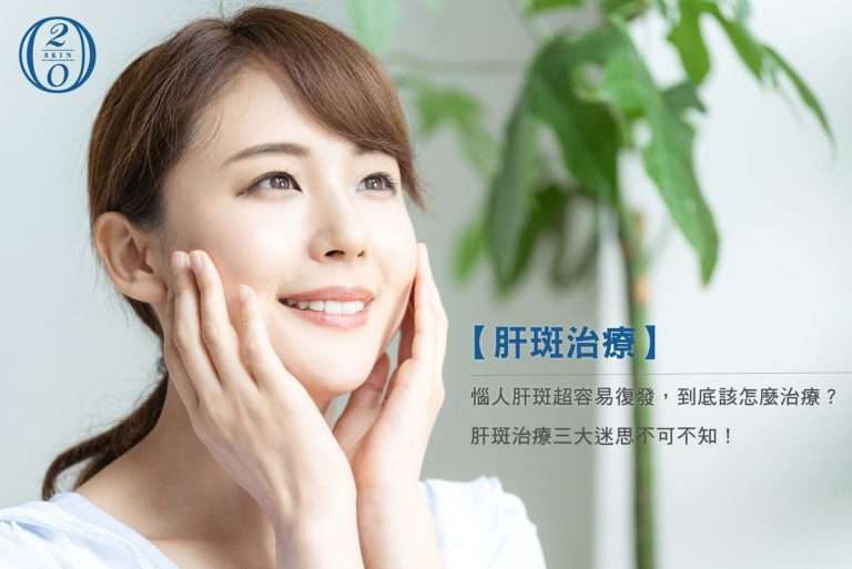 【肝斑治療】惱人肝斑超容易復發,到底該怎麼治療? 肝斑治療三大迷思不可不知 肝斑治療三大迷思不可不知