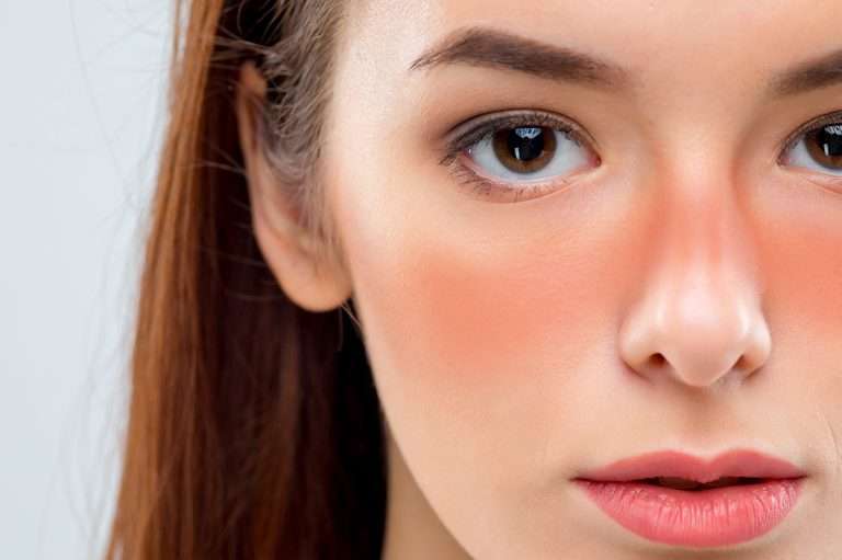 皮秒雷射術後嚴重泛紅、出痧