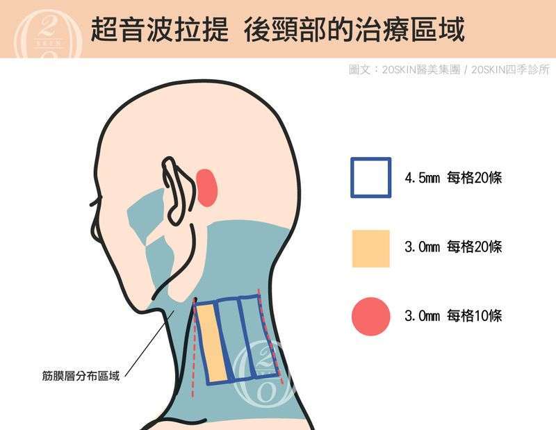 超音波拉提治療後頸部的治療區域