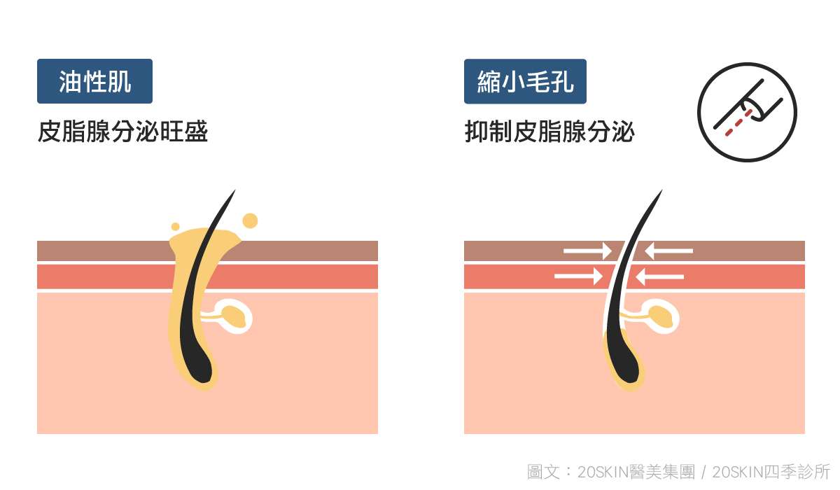 縮小毛孔，也能掐住毛孔的脖子，降低皮脂腺的分泌、減少出油