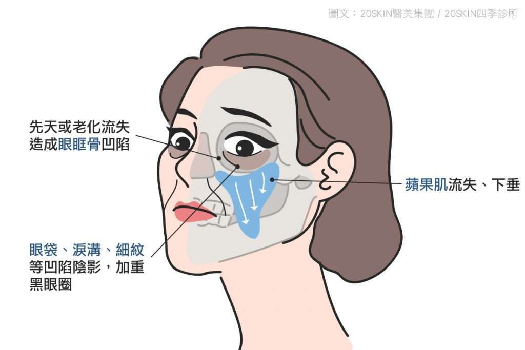在淚溝治療前，由於淚溝的形成原因有很多，需要先找出淚溝的原因。