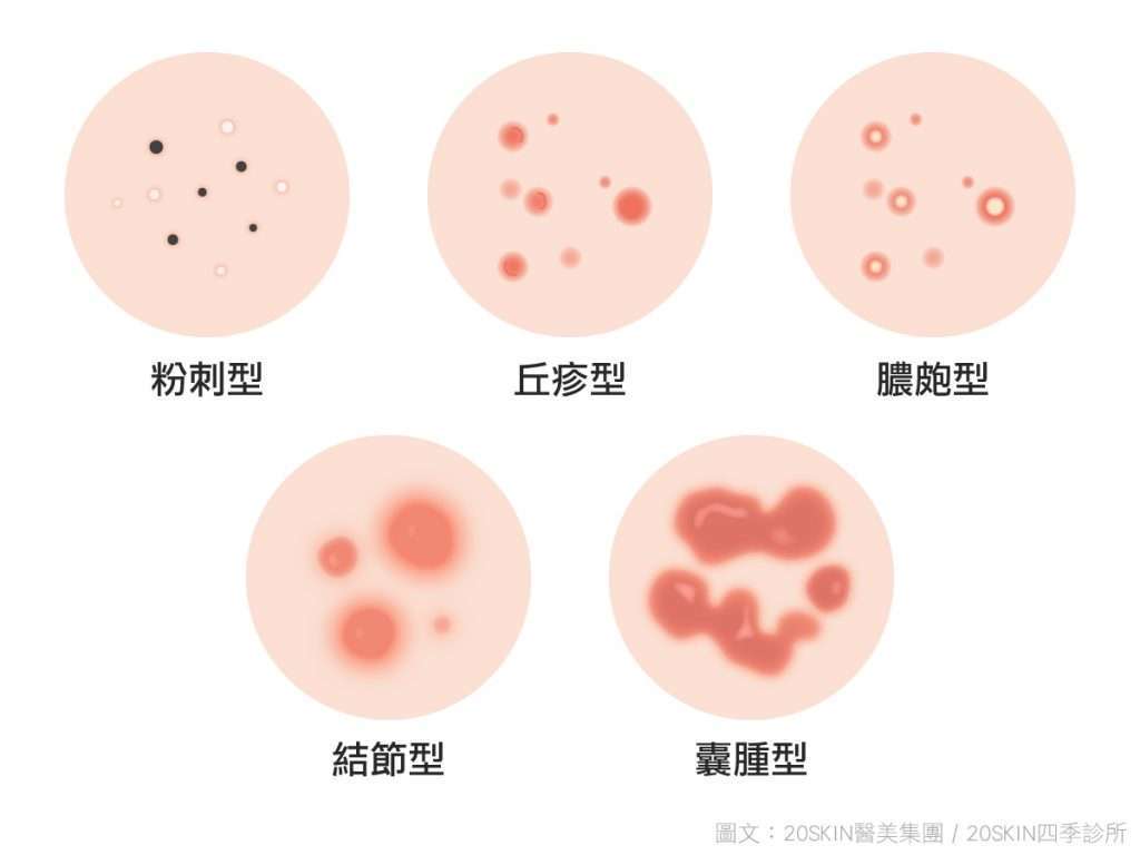 青春痘的五種類型，包含粉刺型、丘疹型、膿皰型、結結型、囊腫型