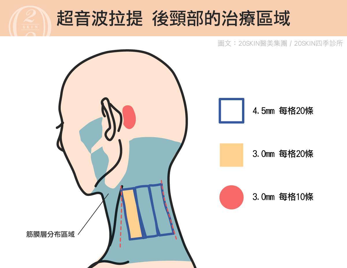超音波拉提後頸部的治療區域
