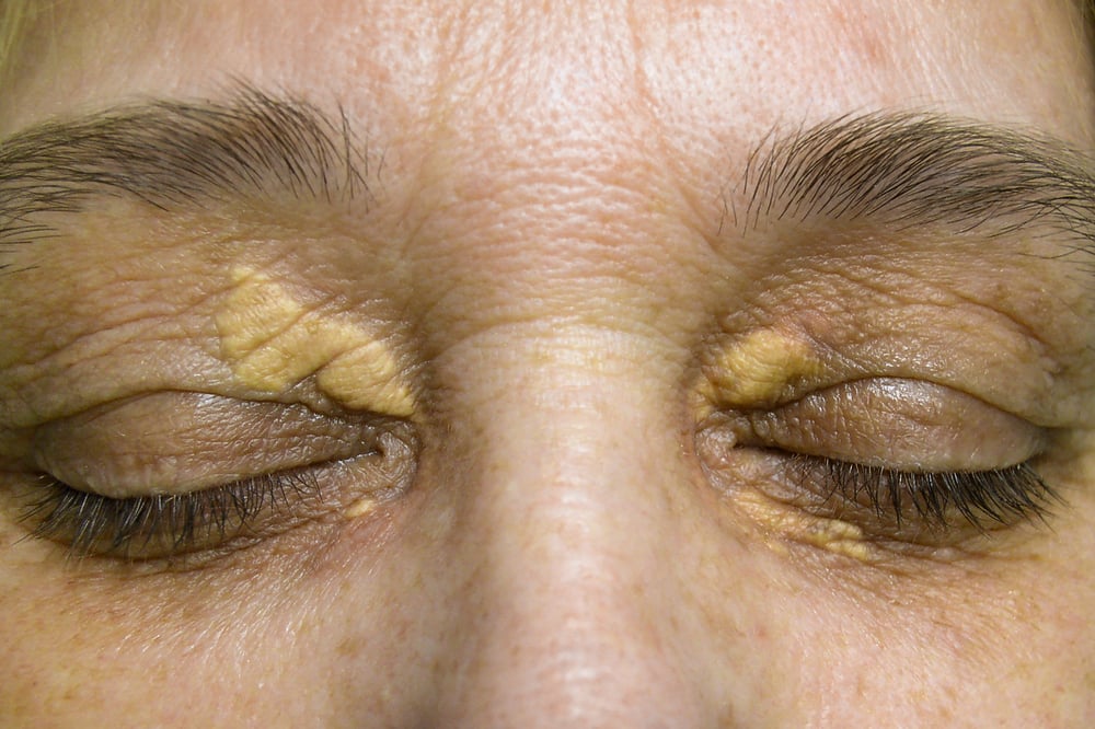 眼瞼黃斑瘤治療前，先認識眼皮上的黃斑瘤是什麼?