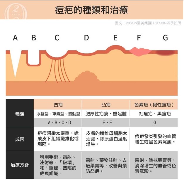 矽谷電波痘疤治療前，先認識痘疤種類