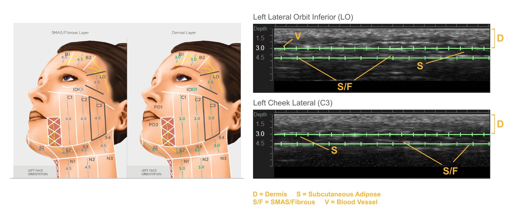 美國音波拉提See, Plan,Treat三部曲